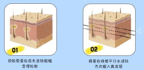 埋线提升手术示意图