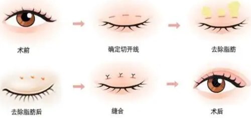 双眼皮手术过程图 双眼皮手术过程图