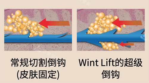 常規(guī)倒鉤線和彈力線對(duì)比