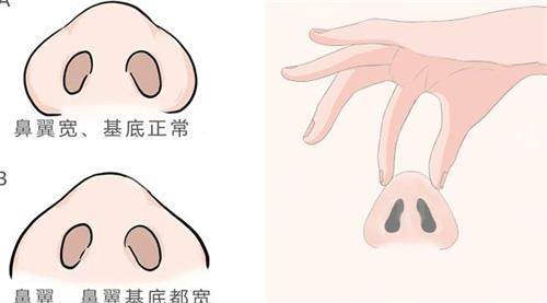 新疆整形美容醫(yī)院鼻子矯正圖