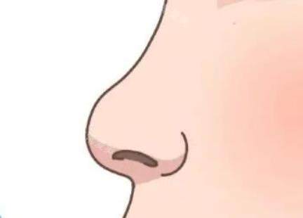 新疆整形美容醫(yī)院隆鼻示意圖