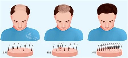 太原麗都整形醫(yī)院植發(fā)圖