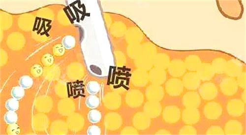 韓國(guó)芙萊思整形醫(yī)院吸脂示意圖