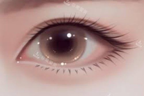 双眼皮手术展示图 双眼皮手术展示图