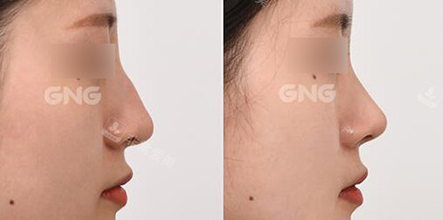 达人推荐：韩国GNG整形做鼻子超厉害！高难度修复很出彩！