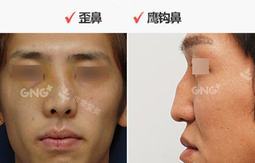 达人推荐：韩国GNG整形做鼻子超厉害！高难度修复很出彩！