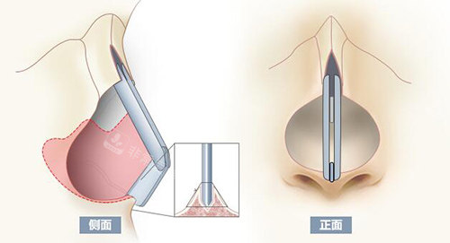 隆鼻改善治疗材料展示