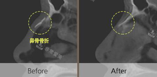 鼻子骨折改善治疗前后对比