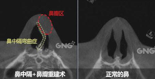 鼻中隔弯曲和正常鼻子对比
