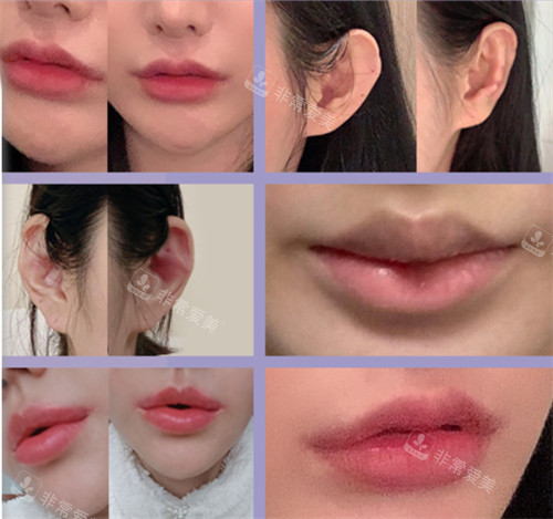 韩国MANO整形外科唇部和耳朵整形成效展示