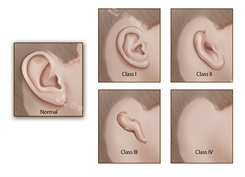 不同的耳朵情况