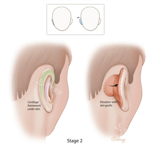 耳朵整形动画图示