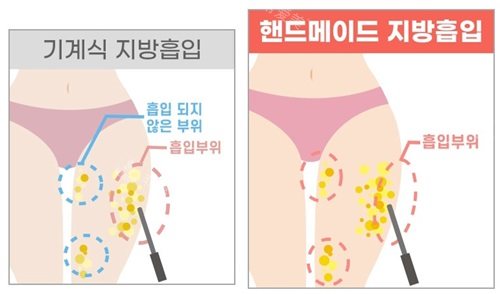 韩国绮林整形医院腿部3650度吸脂示意图
