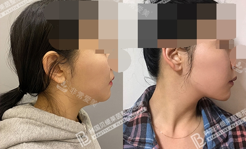 韓國貝緹萊茵整形醫(yī)院雙下巴吸脂 韓國貝緹萊茵整形醫(yī)院雙下巴吸脂