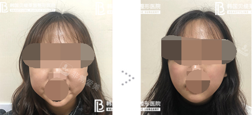 韩国贝缇莱茵整形医院面部吸脂手术实例