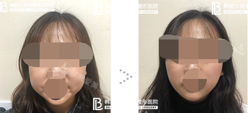 韓國貝緹萊茵整形醫(yī)院面部吸脂手術(shù)實例 韓國貝緹萊茵整形醫(yī)院面部吸脂手術(shù)實例