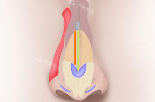 韓國秀美顏整形外科隆鼻修復(fù)示意圖