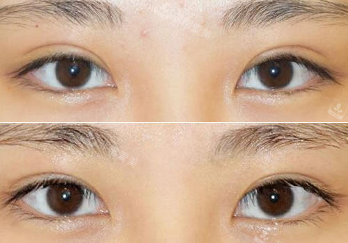 韩国秀美颜整形外科眼修复对比图