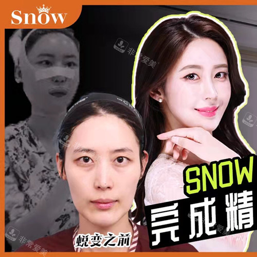 自體脂肪填充面部前后照片 自體脂肪填充面部前后照片