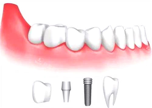 乌鲁木齐美奥口腔种植牙示意图