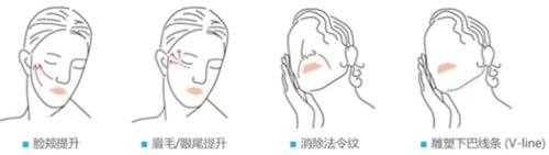 埋線提升的作用 埋線提升的作用