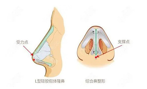 假体隆鼻和鼻综合整形