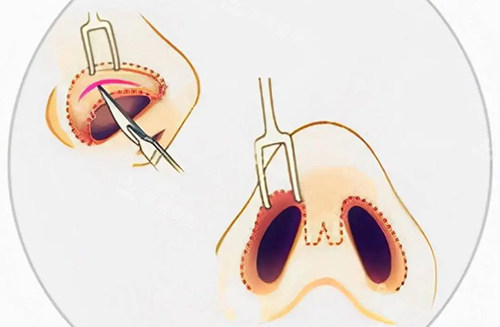 鼻翼和鼻孔整形手术