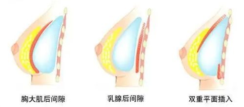 隆胸假體植入位置示意圖 隆胸假體植入位置示意圖