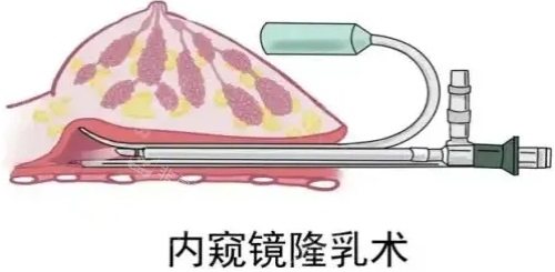 內窺鏡隆胸示意圖 內窺鏡隆胸示意圖