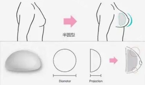 半圓型假體示意圖 半圓型假體示意圖