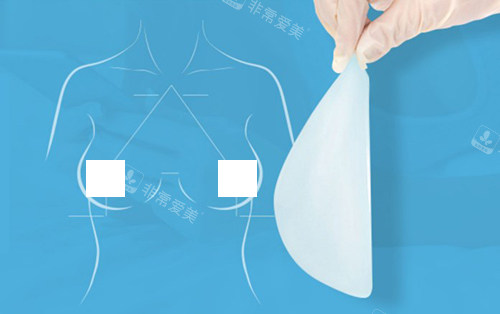隆胸假體手術示意圖 隆胸假體手術示意圖