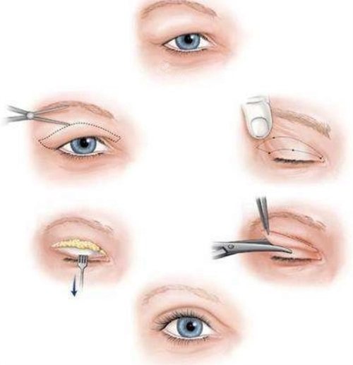 双眼皮修复过程图