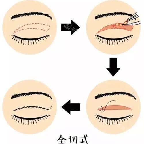 全切式双眼皮