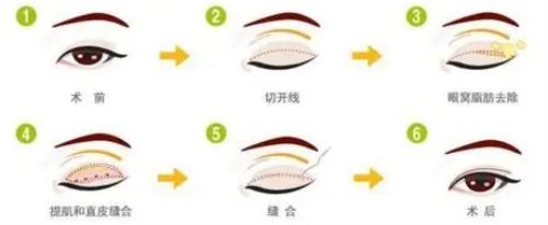 全切双眼皮过程图 全切双眼皮过程图