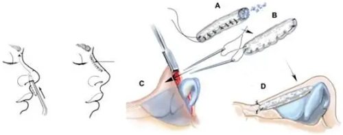 隆鼻手術(shù)過(guò)程圖