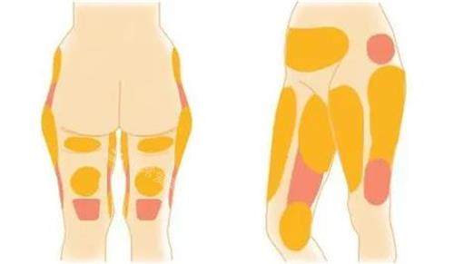 韩国芙莱思医院吸脂部位示意图