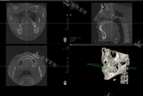 CT检查颌面骨骼影像图
