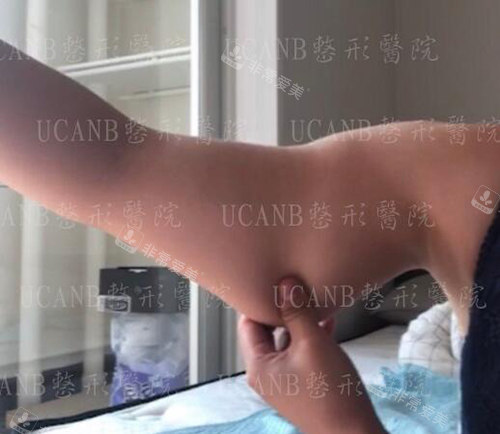 韩国UcanB整形外科手臂吸脂前