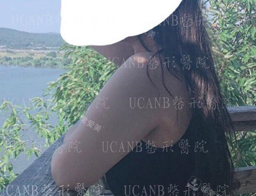 韓國UcanB整形外科做手臂吸脂好嗎