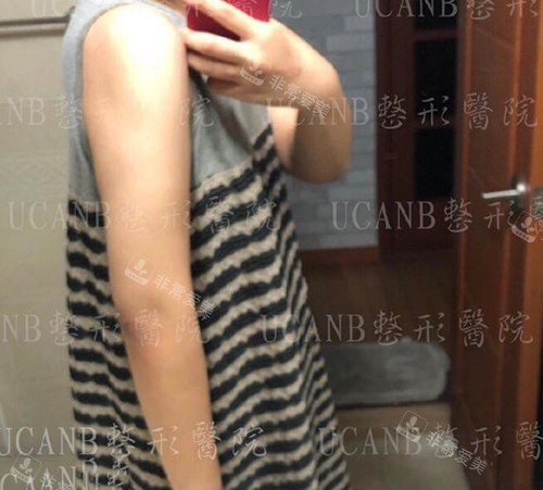 韓國UcanB整形外科手臂吸脂術(shù)后