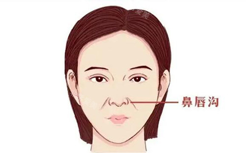 鼻唇溝應(yīng)該如何改善治療 鼻唇溝應(yīng)該如何改善治療