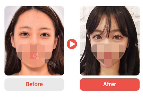 百利酷VG整形外科眼修復(fù)對(duì)比照