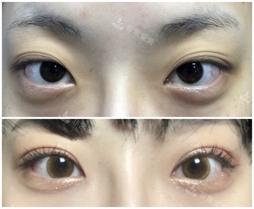 大眼睛整形外科眼修復(fù)對(duì)比照