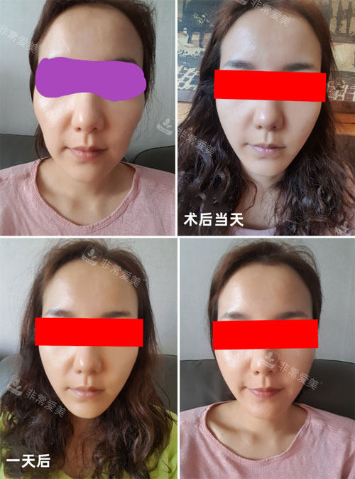 韓國(guó)美爾韓埋線提升面部恢復(fù)照
