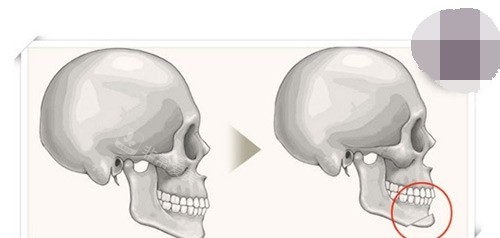 下巴整形手术示意图