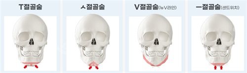 韓國綺林整形醫(yī)院下巴截骨方式 韓國綺林整形醫(yī)院下巴截骨方式