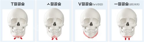 韩国绮林整形医院下巴截骨方式