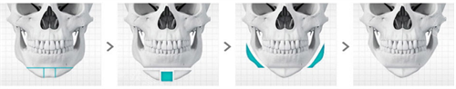 韓國貝緹萊茵整形醫(yī)院下巴過寬截骨