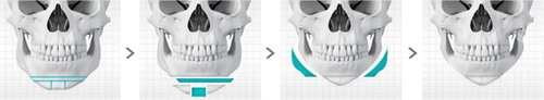 韓國貝緹萊茵整形醫(yī)院下巴過長截骨