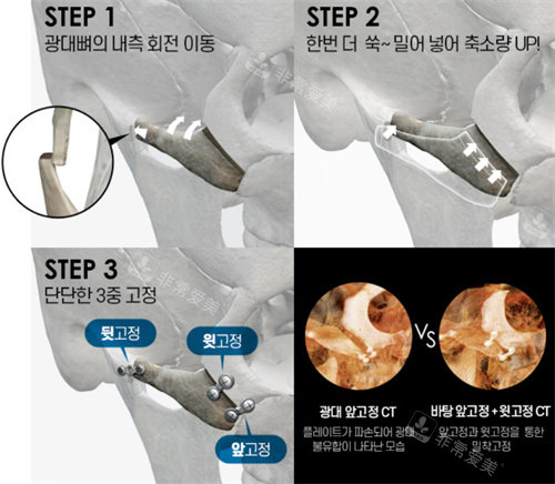 韩国芭堂颧弓整形示意图